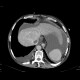 Hepatocellular carcinoma, thrombosis of VCI and right atrium, lung embolism: CT - Computed tomography